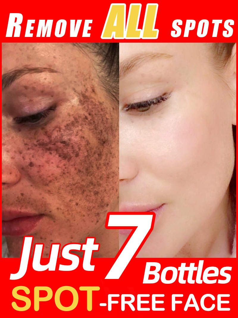 Skincare Luxury Whitening - Ilumine sardas melasma, manchas escuras faciais